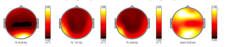 My initial QEEG results showing sustained state of overarousal and exhaustion