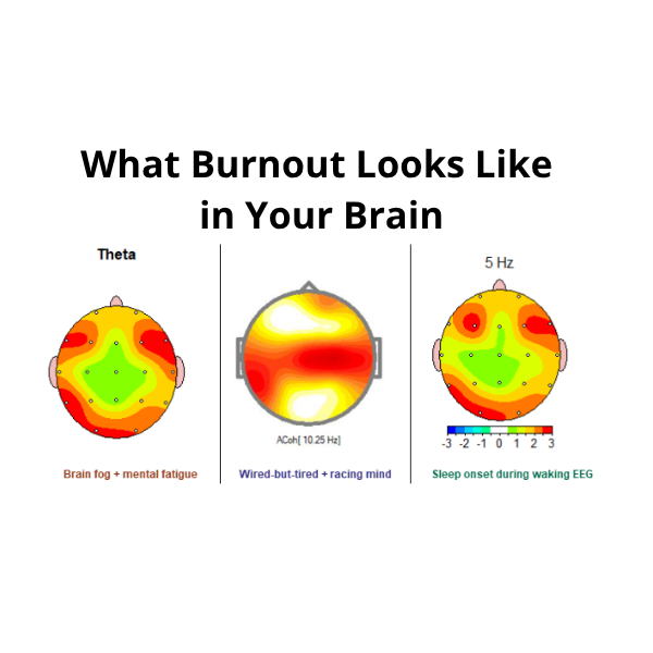 QEEG brain maps showing the neurological signature of burnout: excess slow waves, locked alpha coherence, and near-sleep activity recorded while awake.